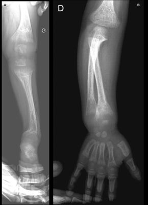 Vitamin D-Resistant Rickets and Cinacalcet—One More Favorable Experience